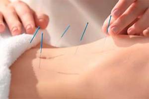 acupuntura en fuengirola