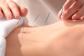 acupuntura-fuengirola.jpg