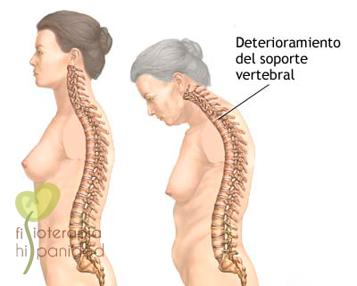 osteoporosis-comumna-vertebral.png